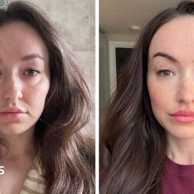 Viral 'Ferritin Face' di TikTok, Dokter Tegaskan Penampilan Tak Cukup untuk Diagnosis